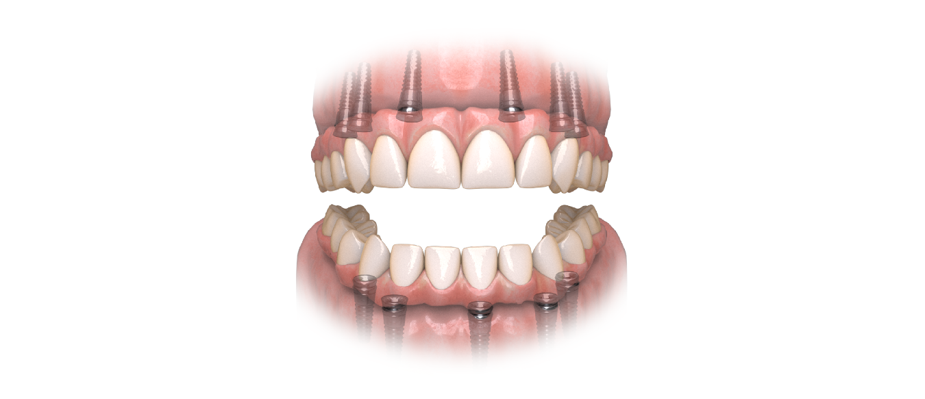 Hybridge Dental Implants