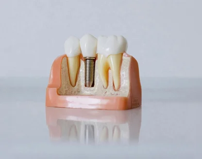 Can Hybridge Dental Implants Replace Loose Dentures Permanently? 